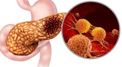 3 người trong 1 nhà đều mắc ung thư tuyến tụy: Bất ngờ với "thủ phạm"