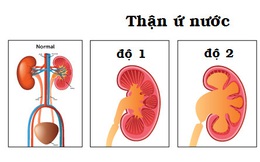 Cách phát hiện sớm thận ứ nước