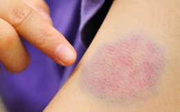 Bầm tím tay, chảy máu tự nhiên: Coi chừng căn bệnh nguy hiểm, ở viện nhiều hơn ở nhà