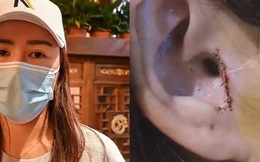 Gái xinh đi sửa mũi bị thẩm mỹ viện "tiện dao" cắt luôn một mẩu tai