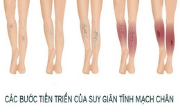 Suy giãn tĩnh mạch chân - âm thầm nhưng đau đớn