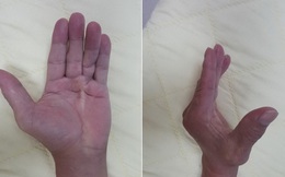 Làm gì khi bị đau co rút bàn tay?