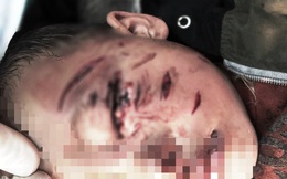 Nghệ An: Bé trai 2 tuổi bị chó nhà cắn rách mặt, tổn thương mắt