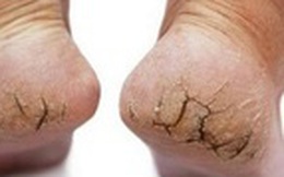 Vì sao thời điểm cuối năm làn da bị 'tàn phá' nhiều nhất?