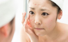 Vì sao thời điểm cuối năm làn da bị 'tàn phá' nhiều nhất?