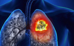 U phổi có phải ung thư: Bác sĩ chia sẻ 3 điều nên biết để người bệnh đỡ hoang mang