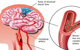 Căn bệnh "sát thủ" có thể gây suy tim, đột quỵ, suy thận: Nguy hiểm nhưng khó phát hiện