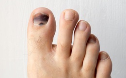 Móng chân chuyển màu đen có thể là nốt ruồi lành tính nhưng nhiều khi cũng là dấu hiệu của các bệnh, bao gồm cả ung thư