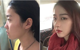 Khóc 3 ngày 3 đêm vì quá đau, gái xinh vẫn khẳng định không hề hối hận khi phẫu thuật thẩm mỹ