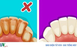 6 mẹo đơn giản giúp bạn có hàm răng trắng sáng