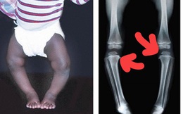 4 sự thật về chân vòng kiềng: Hoàn toàn không phải do bế trẻ như nhiều người tưởng