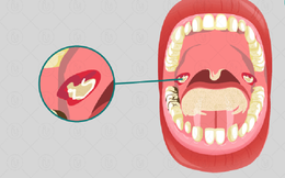 Bệnh nhi 4 tuổi tử vong do bệnh bạch hầu dù đã tiêm vắc xin: Chuyên gia lý giải nguyên nhân
