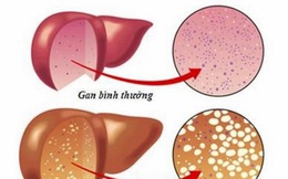 Bạn đã hiểu đúng về gan nhiễm mỡ?