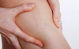 Chân nổi gân xanh, bệnh gì?