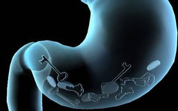 Ngoài ăn cay, 4 thói quen thường gặp này ở giới trẻ cũng có thể làm tổn thương dạ dày nghiêm trọng