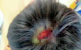 Bé 9 tuổi nghi bị cha bạo hành dã man