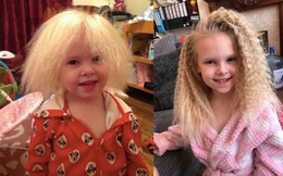 Mắc hội chứng hiếm gặp, bé gái người Anh sở hữu mái tóc y hệt thiên tài Vật lý Einstein