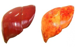 Gan nhiễm mỡ không chỉ do ăn nhiều chất béo: Đây là 4 "kẻ thù giấu mặt" cần cảnh giác