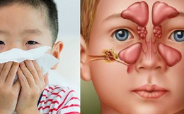Viêm xoang không chỉ là bệnh của người lớn