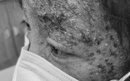 Dùng thuốc trị nấm sai cách, bé gái 8 tuổi bị tổn thương da nghiêm trọng