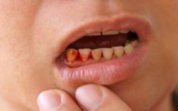 3 dấu hiệu ở răng chứng tỏ gan đang 'kêu cứu': Hãy tự kiểm tra xem bạn có không?