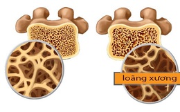 Nhận biết sớm bệnh loãng xương