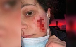 Từ vết cắn đáng sợ trên mặt nữ nhân viên y tế Mỹ