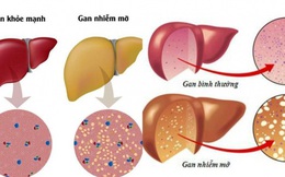 Cần làm gì khi bị gan nhiễm mỡ?