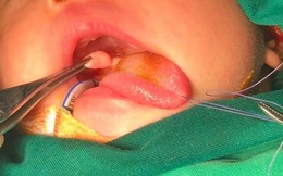 Bệnh viện Răng Hàm Mặt Trung ương HN: Phẫu thuật thành công u gốc lưỡi hiếm gặp cho trẻ 21 ngày tuổi