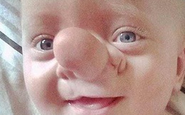 'Cậu bé Pinocchio đời thực” sinh ra với chiếc mũi to dị dạng khiến bố mẹ cũng sốc, gây bất ngờ với diện mạo sau ít năm