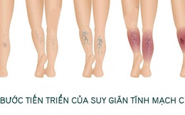 Bài tập cho người suy giãn tĩnh mạch chân