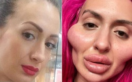 Gái xinh tự tiêm filler 4 năm để có ''gò má cao nhất thế giới'', nguyên nhân do cô thấy mặt mình giống... con chuột