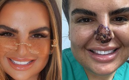 Tiêm filler hỏng suýt rụng mũi và môi, cô gái stress tới nỗi không dám thò mặt ra đường