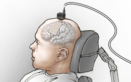 Các nhà khoa học nối não của một người câm với máy tính, và bây giờ anh ấy đã nói được