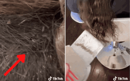 Clip: Màn diệt chấy rận ngàn con nhung nhúc trên đầu bé gái khiến 46 triệu người xem nổi da gà, chuyên gia chỉ muốn bỏ việc vì sợ