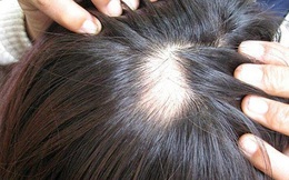 Làm tóc ở chỗ quen, người phụ nữ hoảng loạn vì hói cả mảng đầu chỉ sau 1 đêm