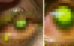 Bác sĩ chia sẻ hình ảnh kinh hoàng về mắt của bệnh nhân đeo kính áp tròng ngủ qua đêm
