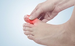 Nam giới mắc bệnh gout ngày càng nhiều, vì một lý do tưởng đơn giản