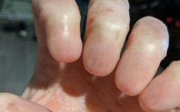 Anonychia - Tình trạng hiếm gặp, khiến cho con người không có móng tay và móng chân