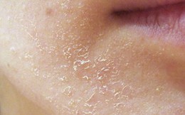 Da khô, nứt nẻ mùa lạnh, bác sĩ bày cách xử lý