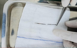 Vào viện khám vì gãy tay, bác sĩ bất ngờ phát hiện kim khâu trong phổi bé trai 4 tuổi