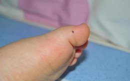 6 vị trí nốt ruồi ở bàn chân mang đến may mắn, tiền tài, địa vị cho chủ nhân
