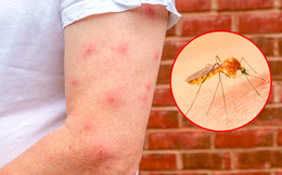Mách bạn 9 cách trị vết muỗi đốt làm dịu cảm giác khó chịu ngay tức thì