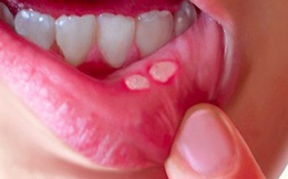 Nhiệt miệng và những điều cần biết
