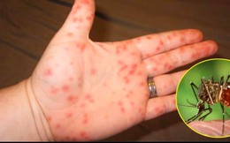 4 giai đoạn của bệnh sốt xuất huyết: Giai đoạn 3 cần chú ý vì dễ nguy hiểm