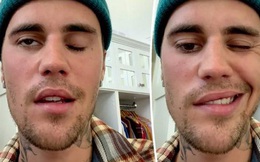Justin Bieber gặp khó khăn trong ăn uống sau khi liệt nửa mặt