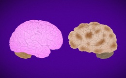 Người ngoài 30 tuổi cần ngăn ngừa bệnh Alzheimer khi có những dấu hiệu cảnh báo này