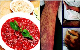 Không ăn tiết canh vẫn mắc bệnh hiểm