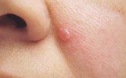 4 năm chữa nốt sần dưới cánh mũi không khỏi, người phụ nữ mắc bệnh nguy hiểm ít người để ý