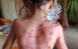 Phú Thọ: Công an "vào cuộc" vụ bé gái bị hàng xóm dội cả ấm nước sôi vào người
